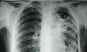 Заболеваемость туберкулёзом увеличилась в СКО