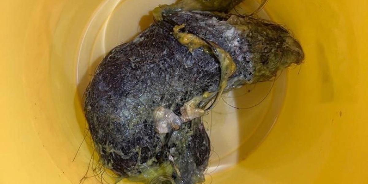 Килограммовый ком волос извлекли из желудка подростка в Таразе