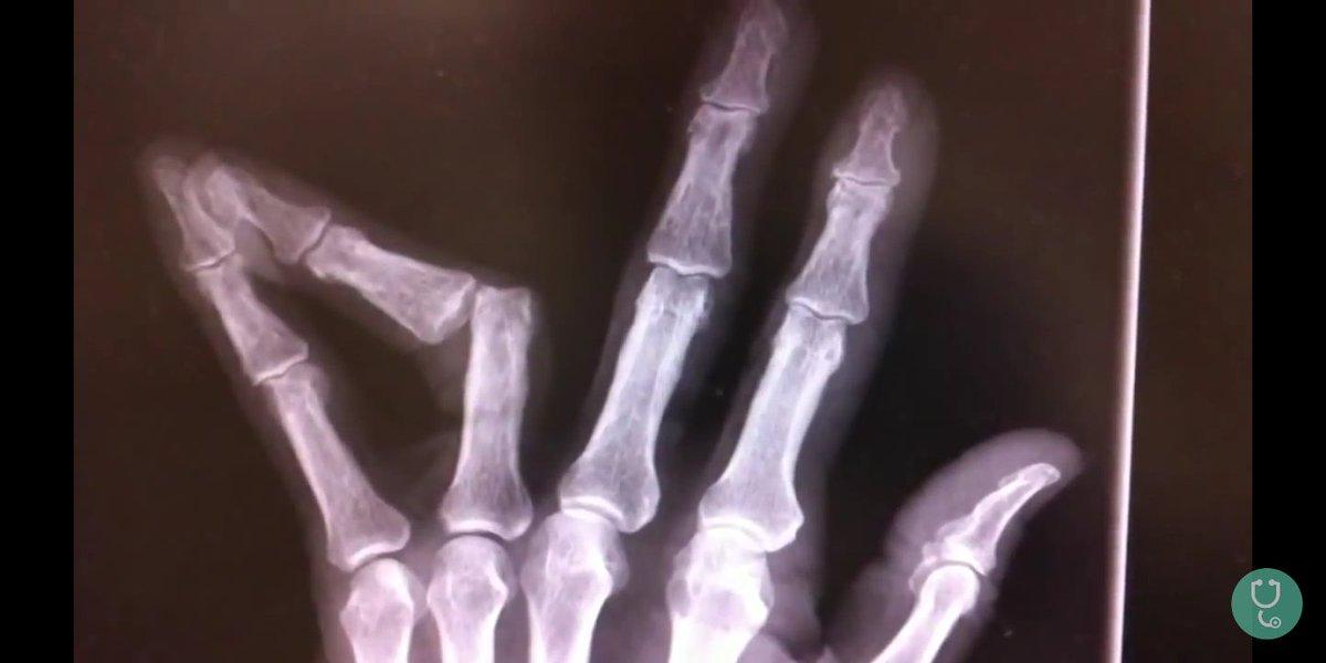 Девочке оторвало палец в частном садике Атырау